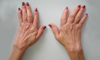 Artritis en les mans